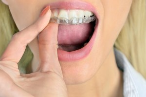 Photo: A woman removing a clear a mouth guard