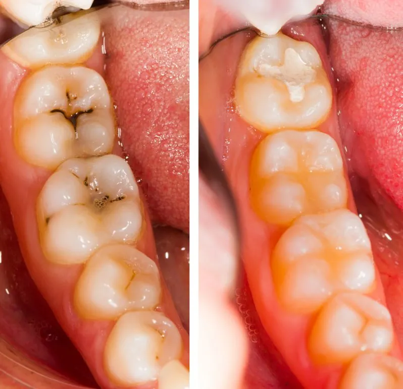 Before and after image of composite restorations or fillings