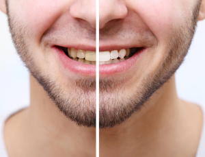 Before and after image for teeth whitening, left and right split image