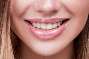 Before and After Teeth Whitening - left and right split, woman smiling