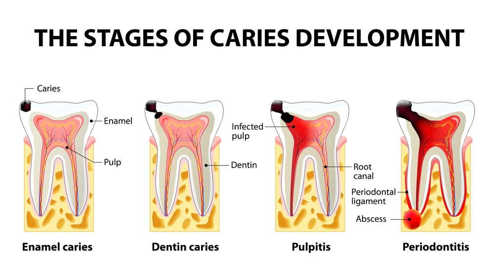 An image displaying the stages of caries development