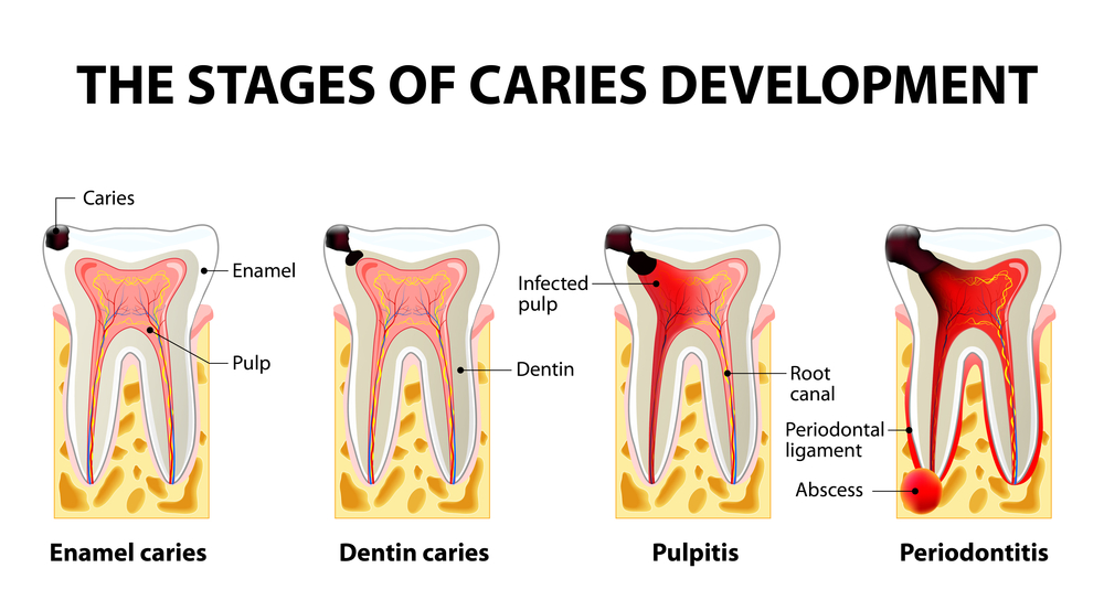 dental caries treatment